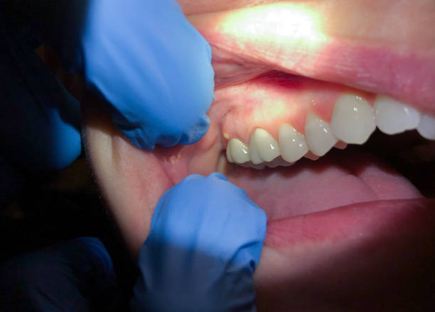 Best Knocked-Out Tooth (Avulsed Tooth) Treatment in Torrington, CT